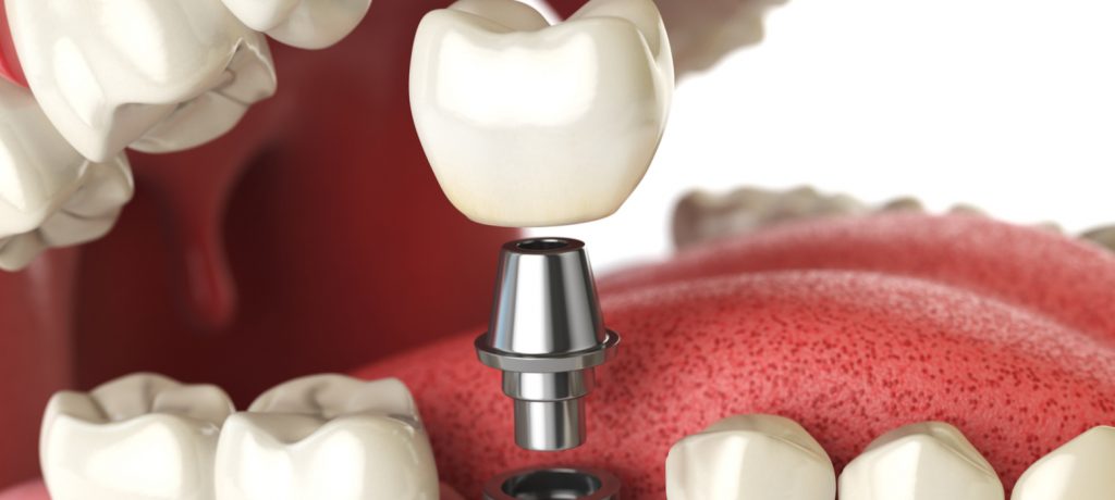 Healthy Aging Month: Understand Your Options for Tooth Replacement!