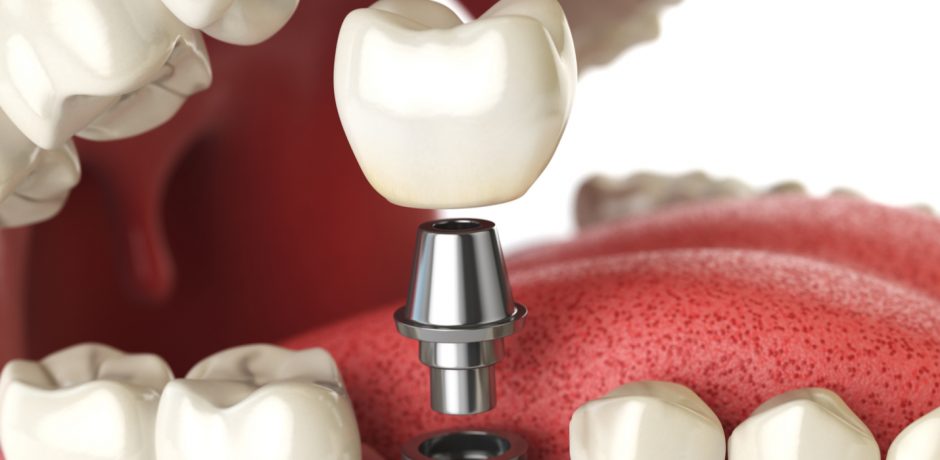 Healthy Aging Month: Understand Your Options for Tooth Replacement!
