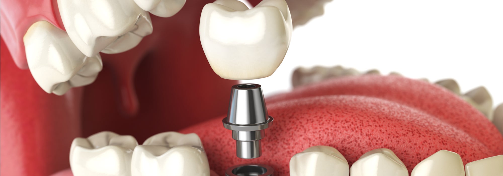 Dental implant concept with tooth being anchored into the jaw.
