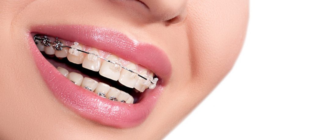 5 Reasons You Might Need to Get Braces