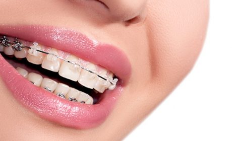5 Reasons You Might Need to Get Braces