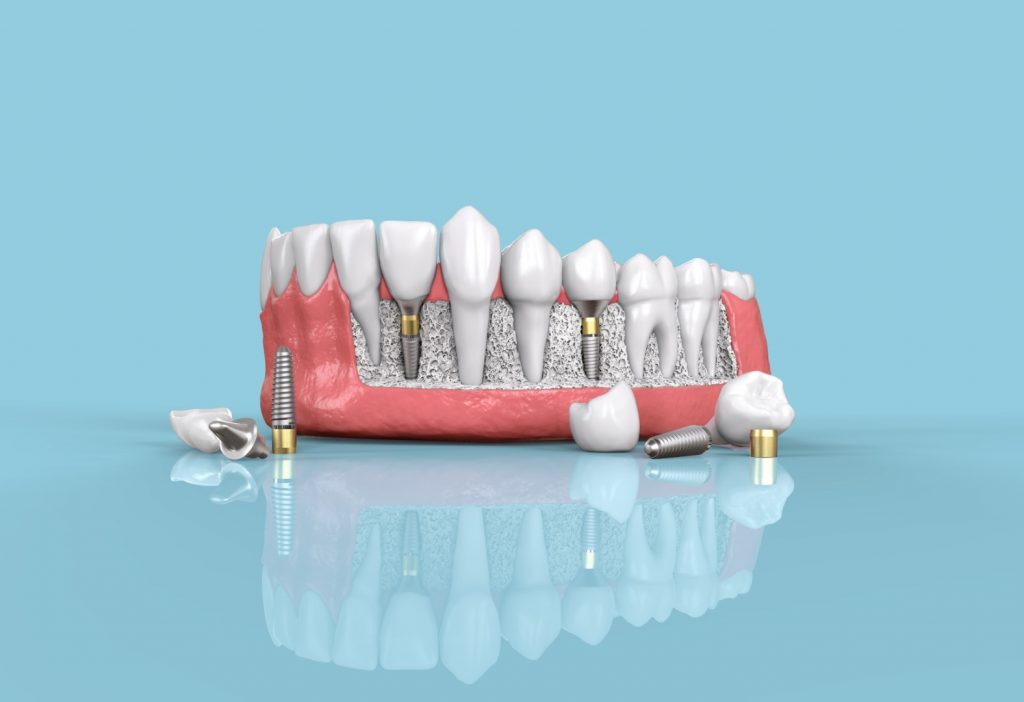 An illustration of a jaw and teeth is showing several teeth replaced with dental implants.
