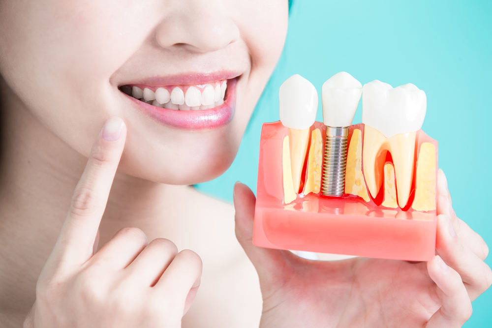  A woman points to her smile with her right hand and holds a plastic model of affordable dental implants in her left. 