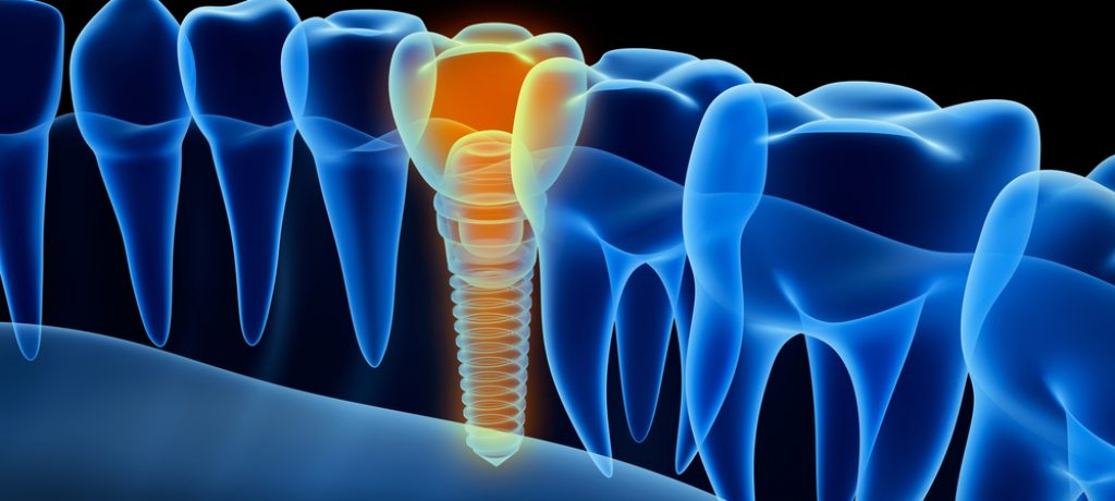 The Dental Implant Process: A Step by Step Guide