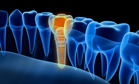 The Dental Implant Process: A Step by Step Guide