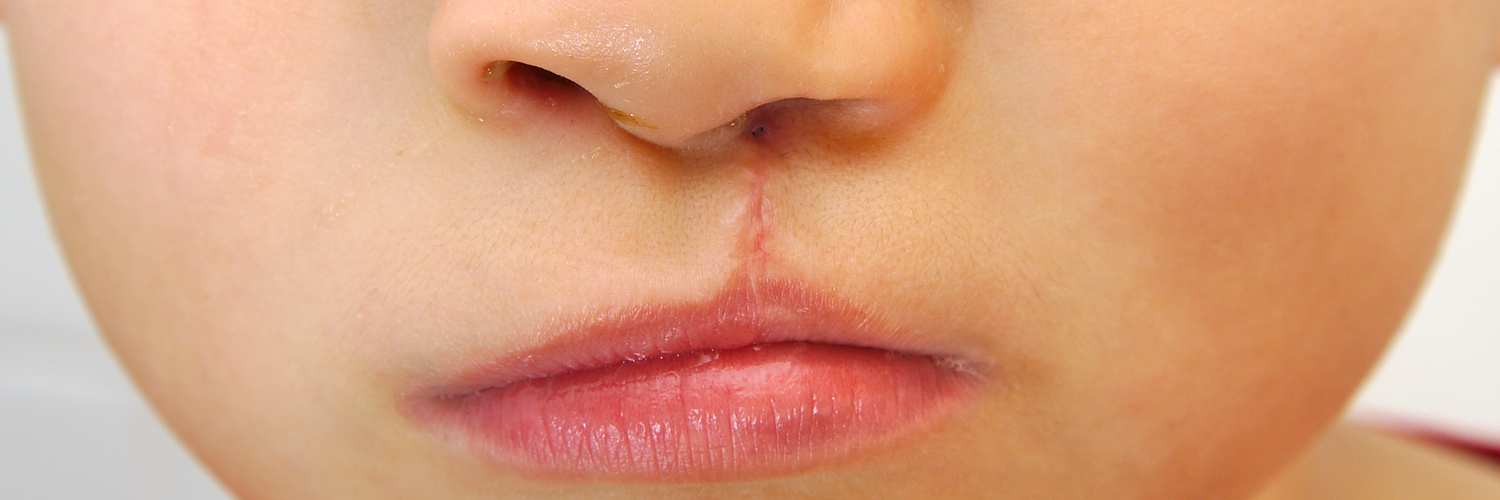 Learn the Basics for National Cleft and Craniofacial Awareness Month