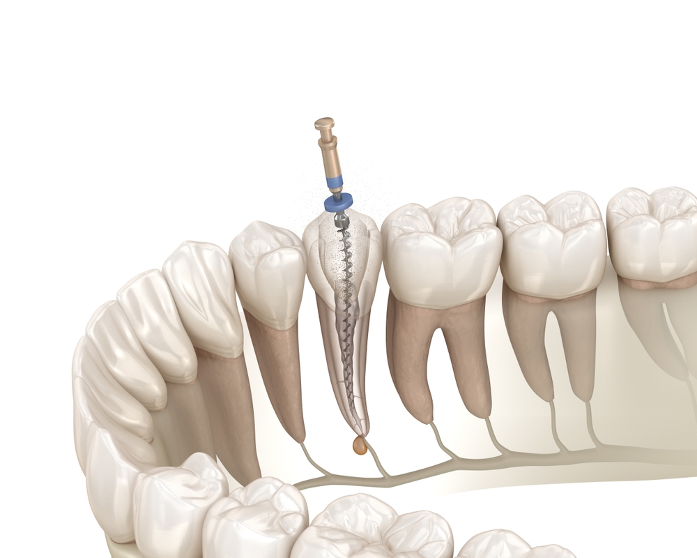  A 3D illustration of a root canal being performed on an infected tooth. 
