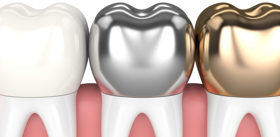 What Are Dental Crowns Made Of, Anyway?