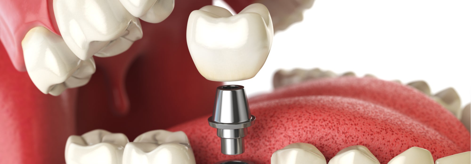 FAQ for Dental Implant Doctors: “How Many Implants Should I Do at One Time?”