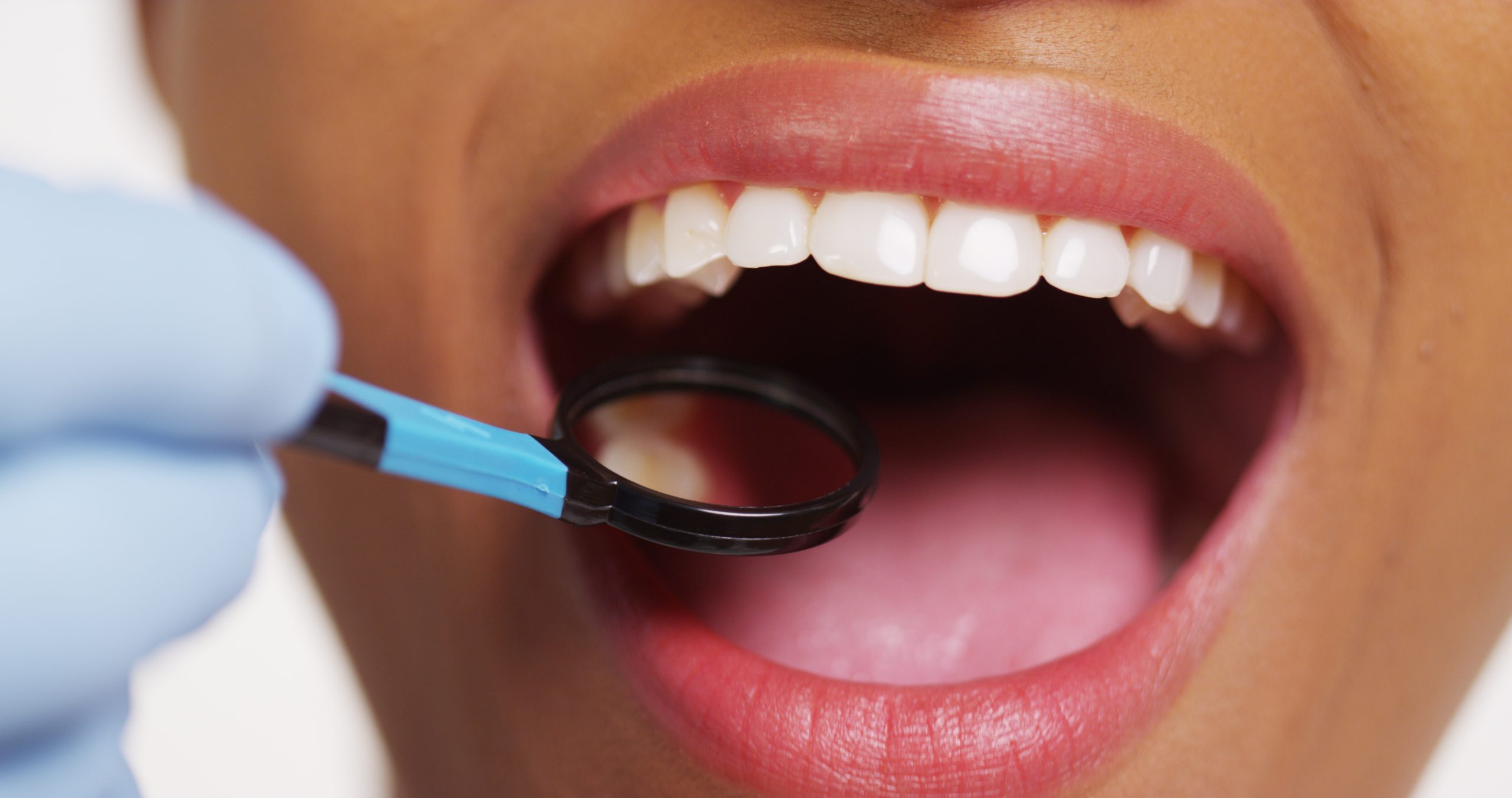 Tooth Cracks & Craze Lines: Here What You Should Know » Top