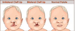 Cleft And Craniofacial Awareness