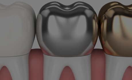 Dental Crowns 101: Types of Dental Crowns and What They Cost