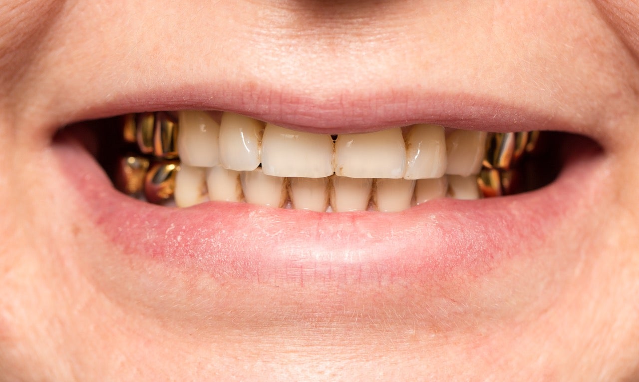Man smiles, showing affordable gold crowns on the upper and lower molars on both sides of his mouth.