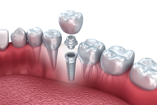 Tooth human implant, 3d illustration.