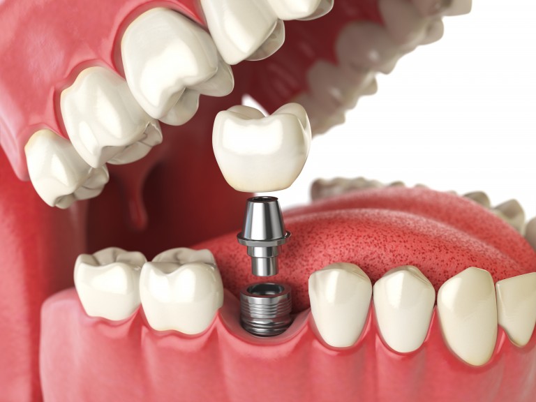 Tooth human implant. Dental concept. Human teeth or dentures. 3d illustration.