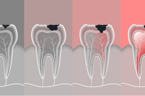 process teeth problem with vector.
