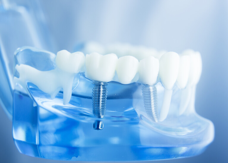 Blue-tinted model of teeth with a dental implant.