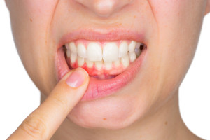 Close up of a woman’s mouth as she points to possible gum disease and/or tooth infection.
