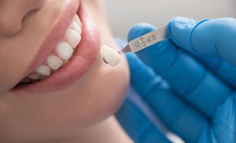 Dental Crowns: What They Are and What They Cost