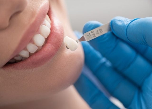 Dental Crowns: What They Are and What They Cost