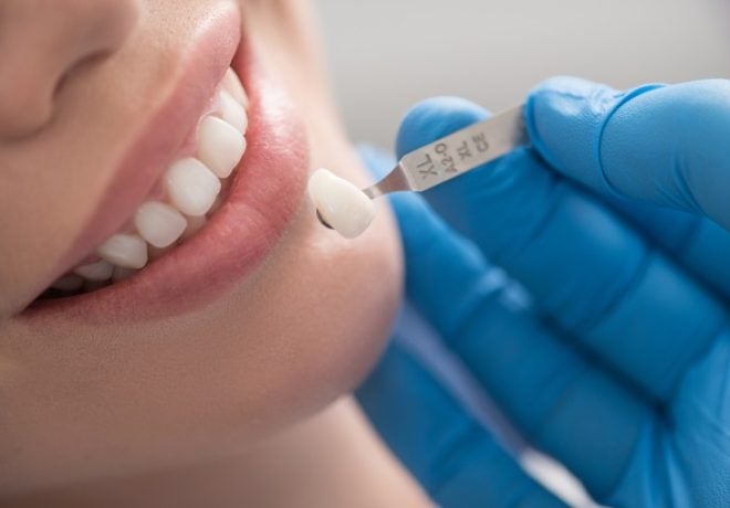 Dental Crowns: What They Are and What They Cost