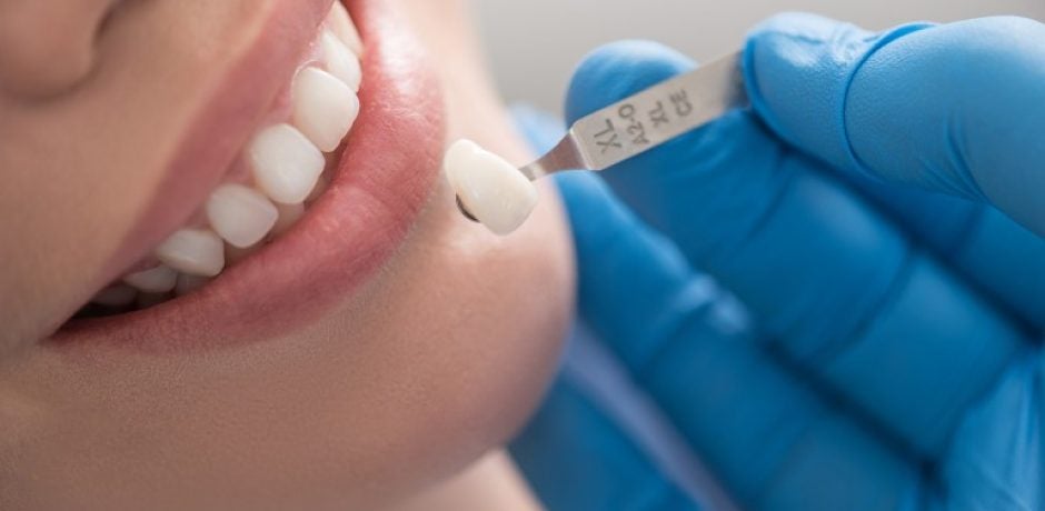Dental Crowns: What They Are and What They Cost