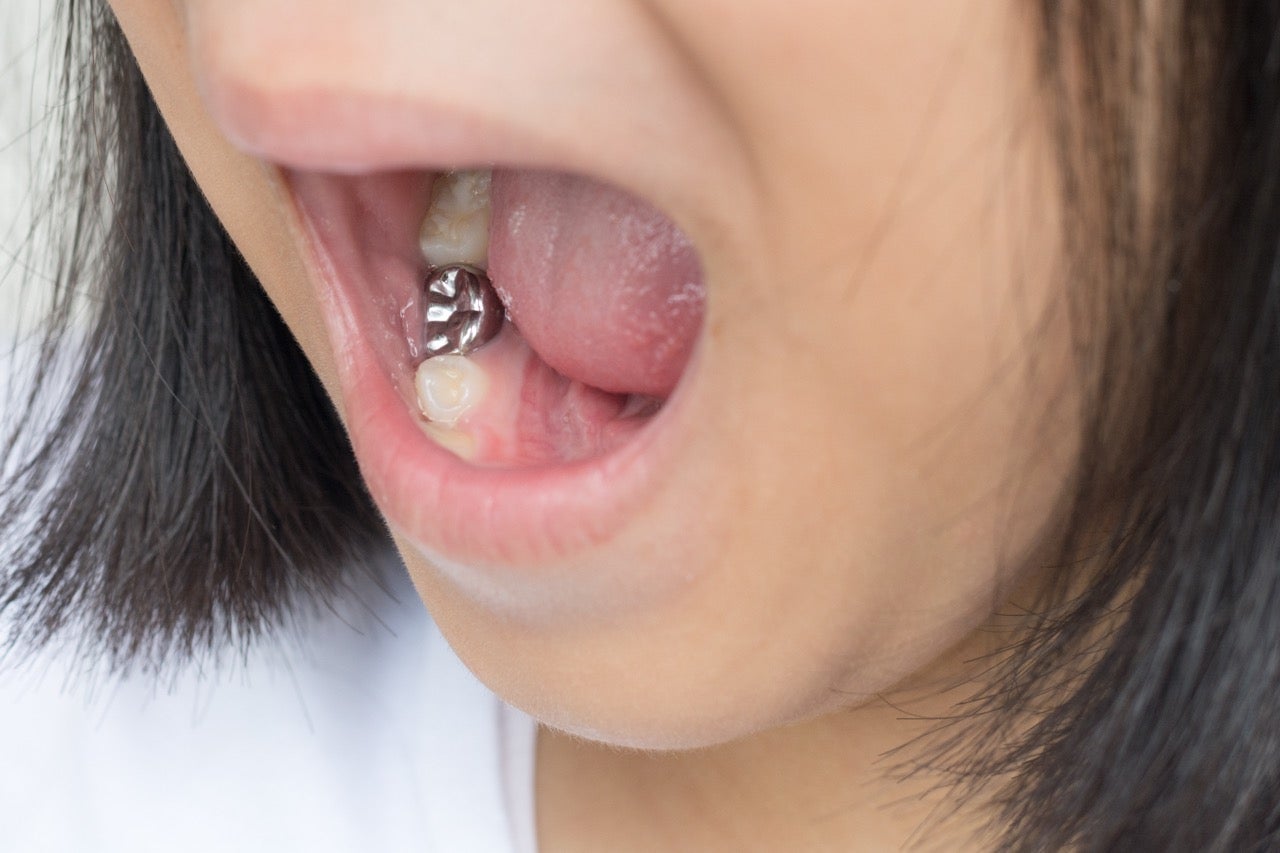 Woman opens her mouth to show affordable silver amalgam crown on a lower right tooth in her mouth. 