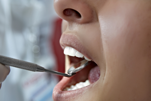 Close up of an African American dental patient receiving a dental exam.
