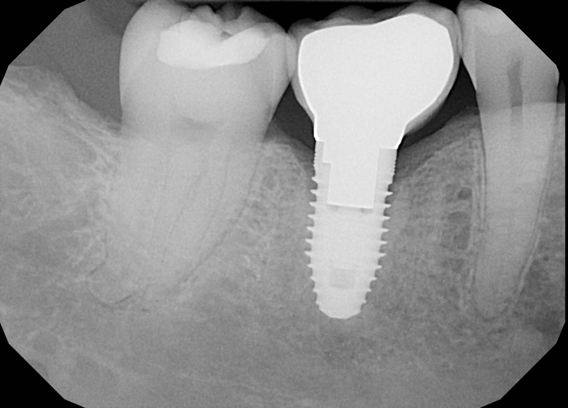 A digital dental X-ray at Penn Dental Medicine shows a dental implant between other teeth. 