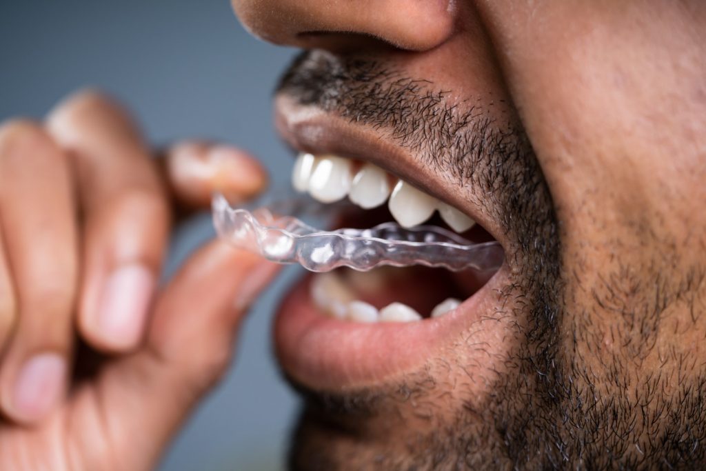 A man places a clear aligner on his upper teeth, part of his treatment with an affordable orthodontist in Philadelphia.