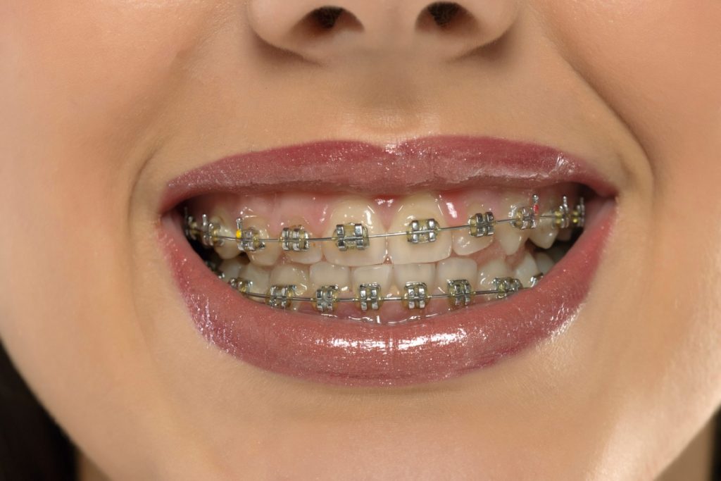 An adult woman smiles, showing traditional metal braces on her teeth.