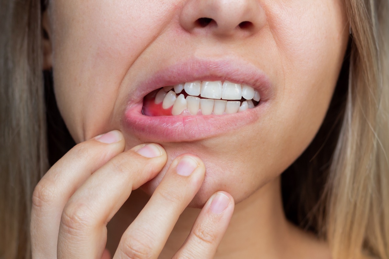 Young pregnant woman pulls down her lower lip, revealing inflammation of her gums.