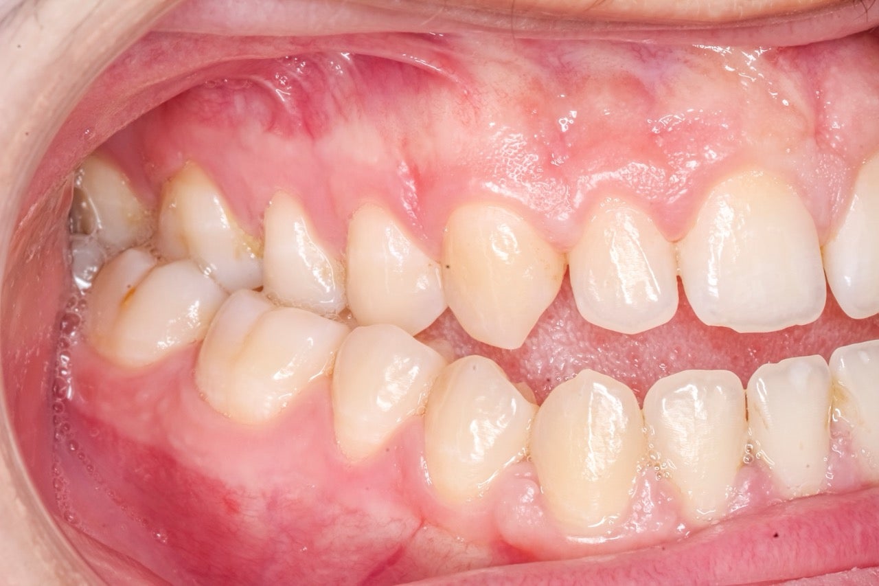 A mouth showing a crossbite. 