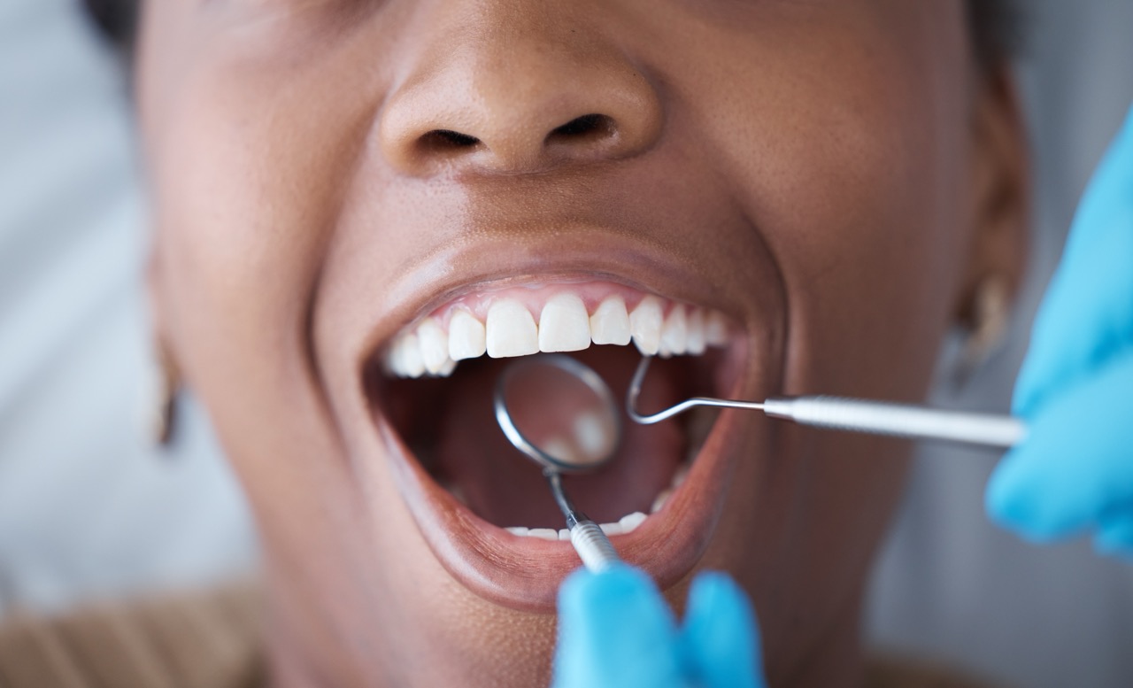 A woman’s open mouth and a dentist’s hands holding a mirror and tools up to her teeth. 