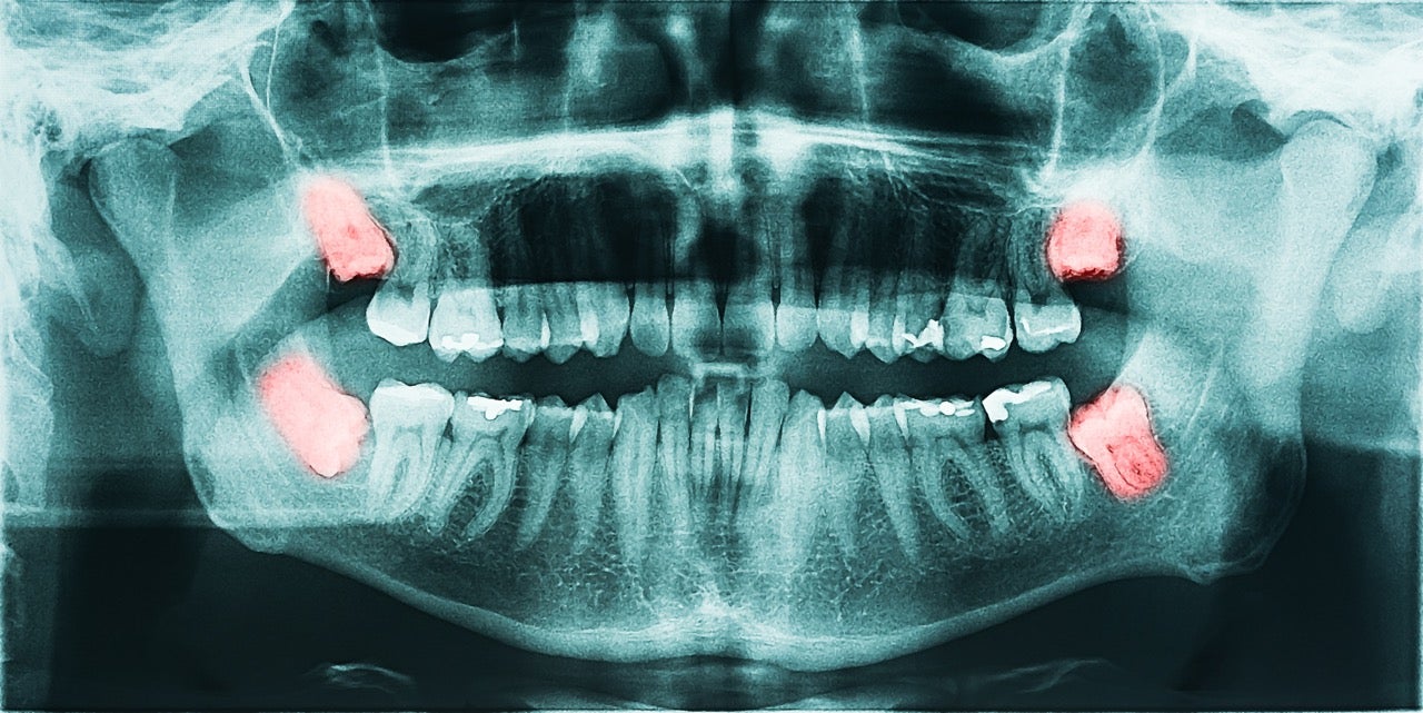 An X-ray showing four wisdom teeth. 