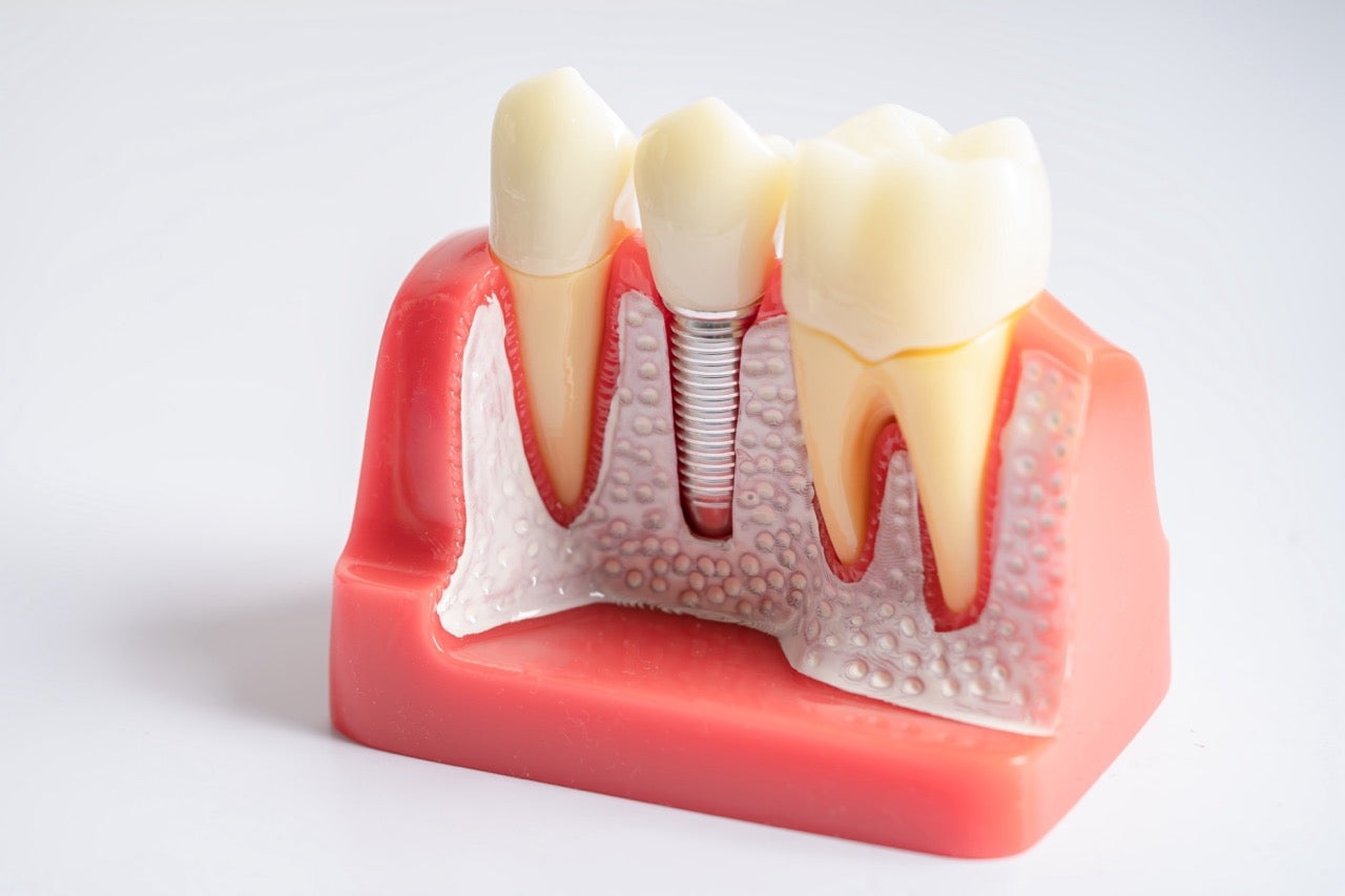A cross-section model showing teeth, gums, and a dental implant. 
