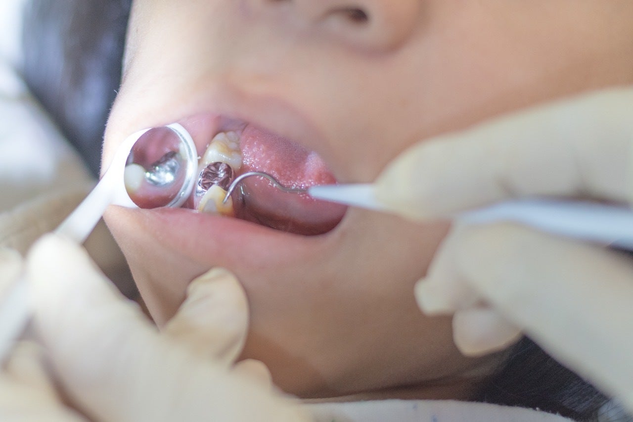 Dentist uses dental pick and mirror to inspect silver dental amalgam filling in a patient’s lower teeth.
