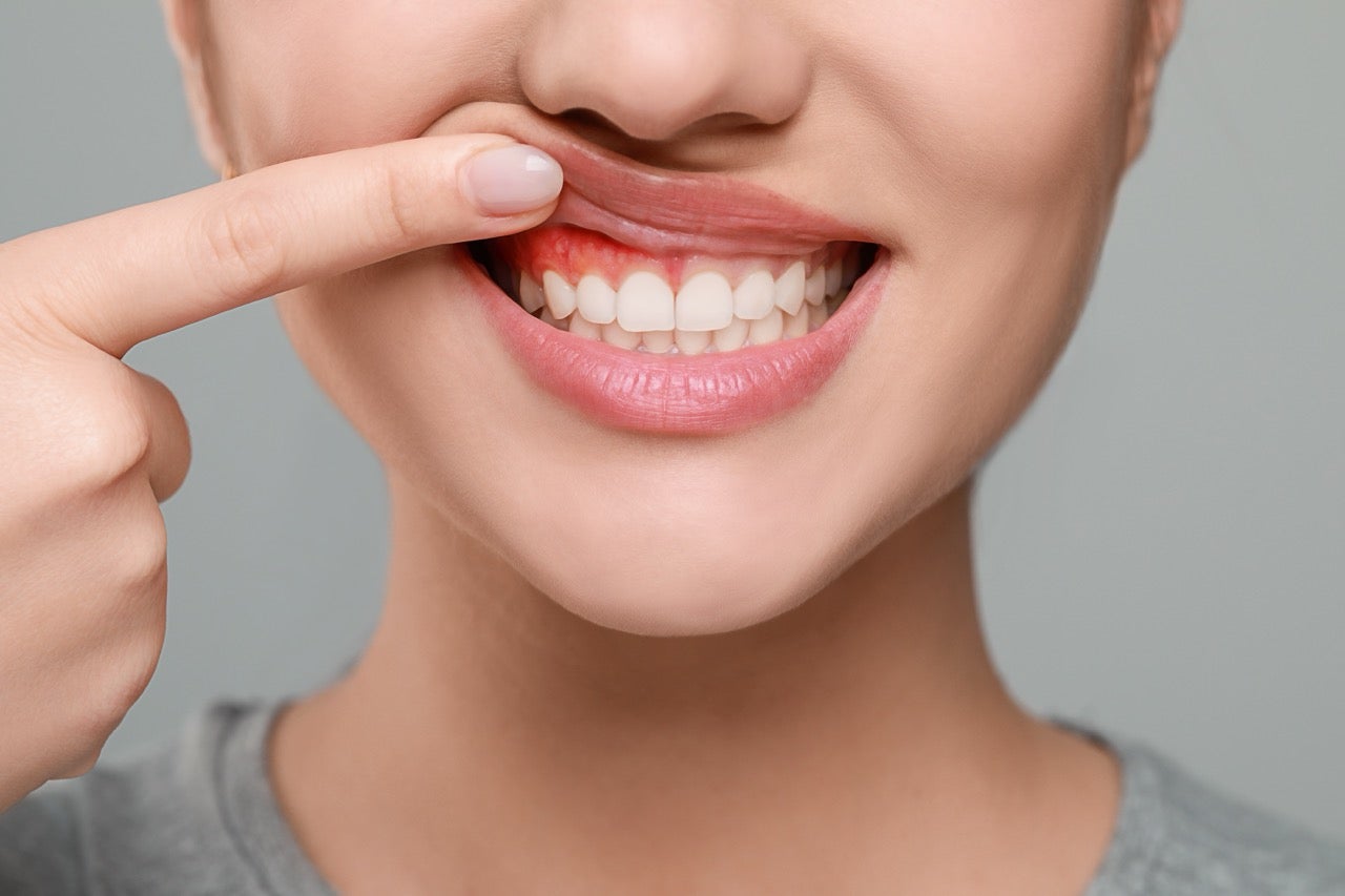 A woman pulls up her lip with her finger to show the red, inflamed gum above her teeth. 